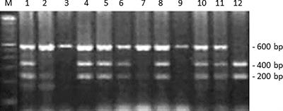 Alpha2beta1 Integrin Polymorphism in Diffuse Astrocytoma Patients